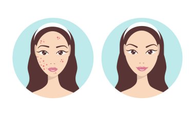 Yüzünde sivilceler olan bir kız. Gençlerde sivilce tedavisi. Tedavinin aşamaları. Öncesini izle. dermatolojik ve hormonal cilt sorunları