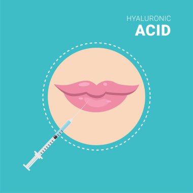 Hyaluronik asit enjeksiyonu. Lip hacim artırma vektör çizimi