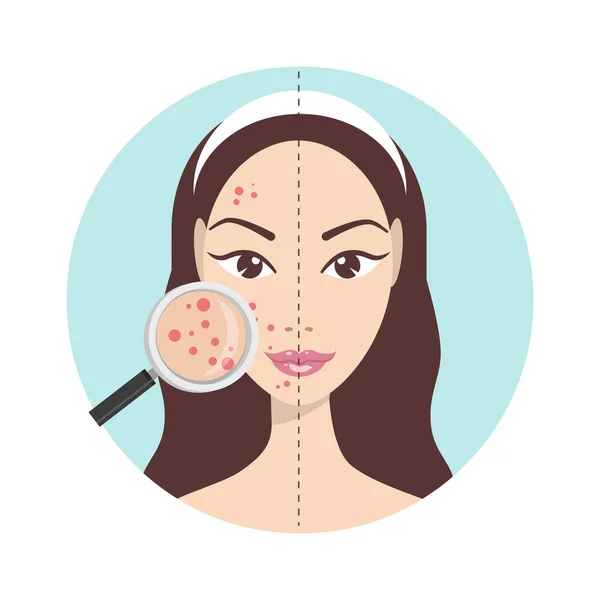 Akne Hautprobleme Teenagermädchen Mit Lupe Zystische Akne Auf Ihrem Gesicht — Stockvektor