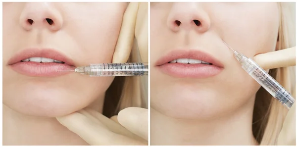 Vrouw krijgt een injectie in haar gezicht — Stockfoto