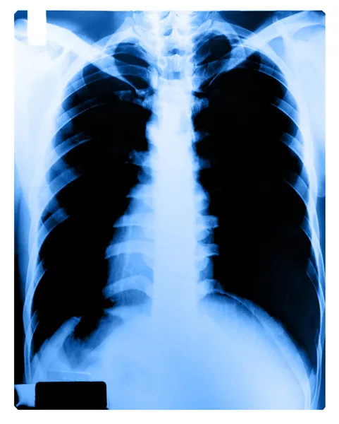 Röntgenbild av människans bröst — Stockfoto
