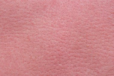 sterke zonnebrand huid