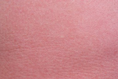 sterke zonnebrand huid