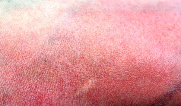 Sunburned skin — Stock Photo, Image