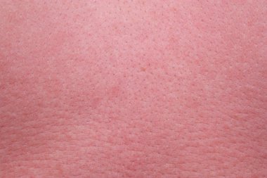 sterke zonnebrand huid