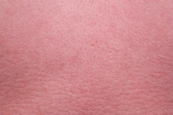 Strong sunburn skin — Stock Photo, Image