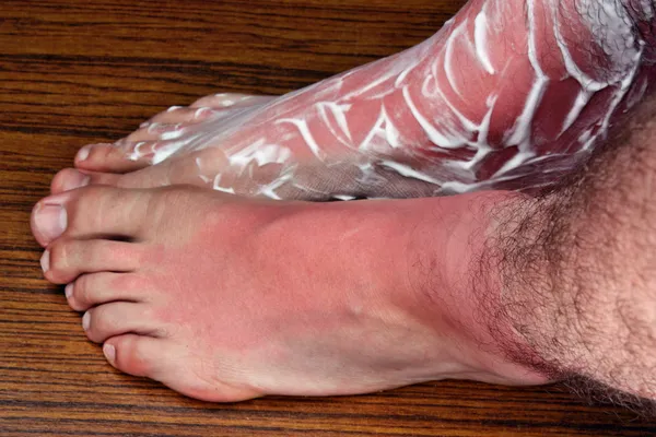 Sunburn legs — Stock Photo, Image