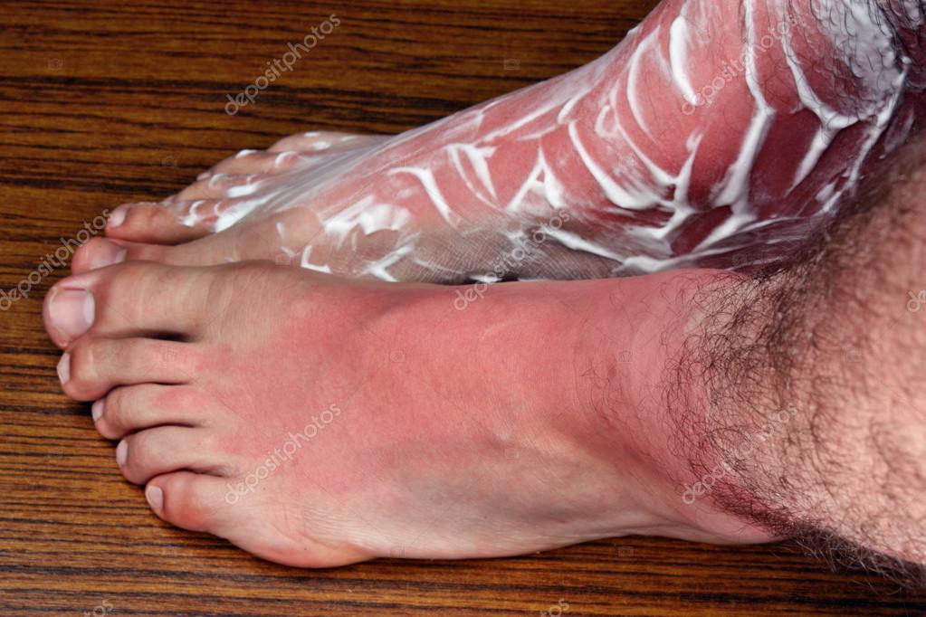 Feet Sunburn Stock Photos Royalty Free Images Depositphotos Feet Sunburn Stock Photos Royalty Free Images Depositphotos