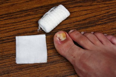 tedaviden sonra batık ayak tirnagi kaldırılması