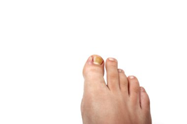 Removed ingrowing toe nail clipart