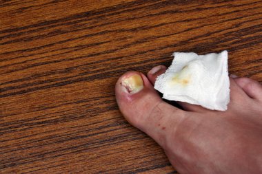 Ingrown toenail with dressing clipart