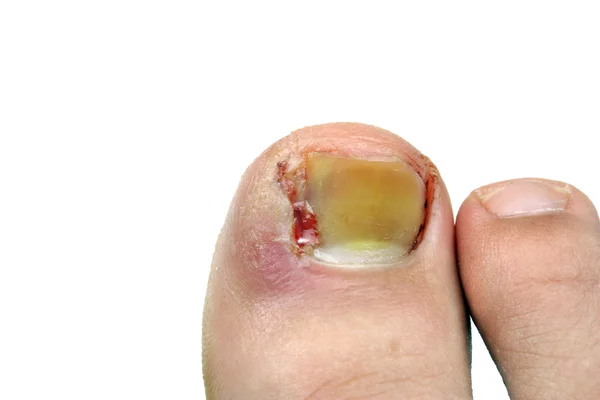 Ingrown toenail after surgery — Stock Photo, Image