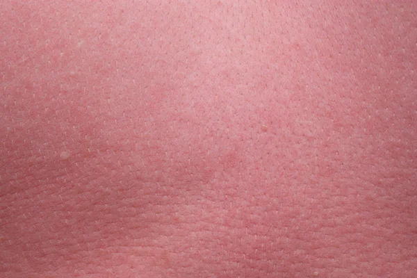 Sunburn skin — Stock Photo, Image