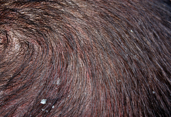 Перхоть в волосах
