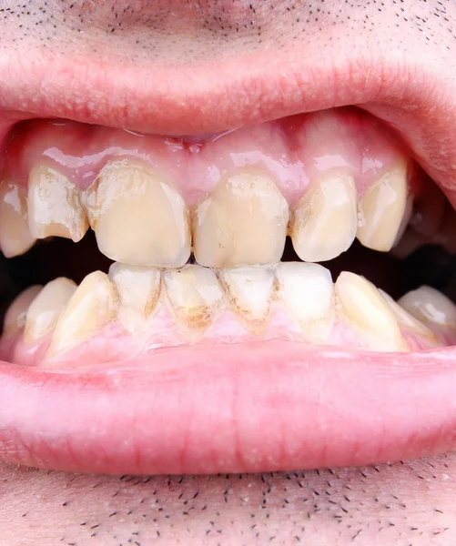 Tartar ve diş çürüğü