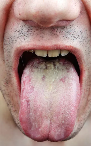 Disease tongue — Stock Photo, Image