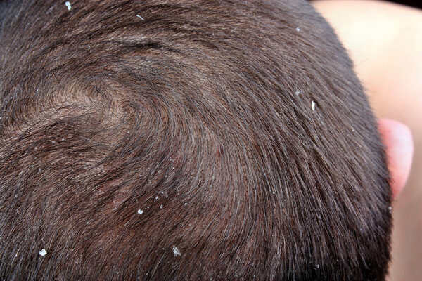 Dandruff in the hair