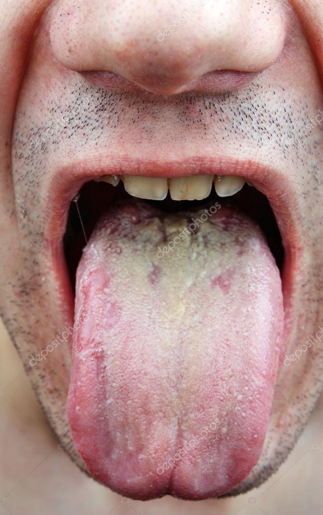 Krankheit Infektion Zunge, Rachen ein Mann.