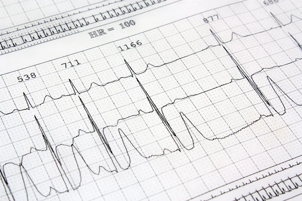 Electrocardiogram ekg heart — Stock Photo, Image