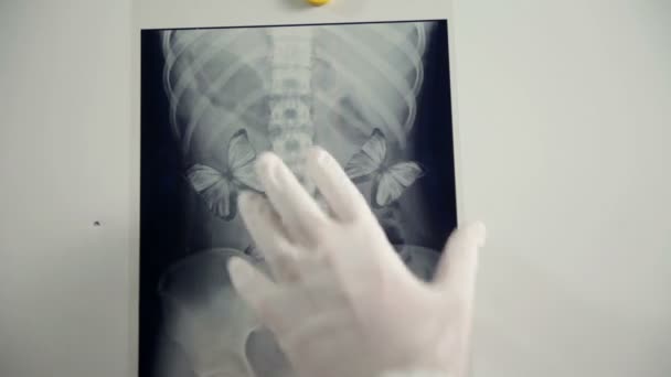 Butterflies in stomach on x-ray — Wideo stockowe