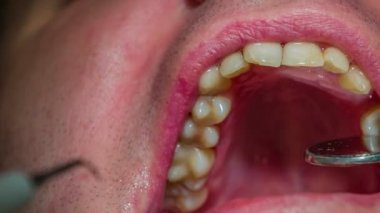 diş hekimi müşterinin dişleri bir ayna ile kontrol