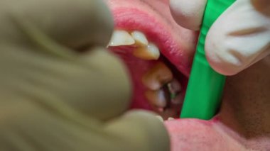 diş hekimi hastanın dişleri asisstant'ın yardımı ile tamir