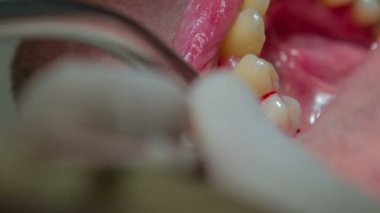 Hastanın sakız dişçi müdahalesi nedeniyle kanama