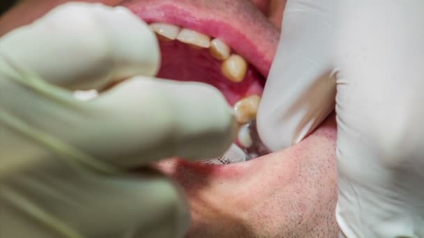 Dentysta wstrzykuje znieczulenie stomatologiczne pacjenta guma — Wideo stockowe