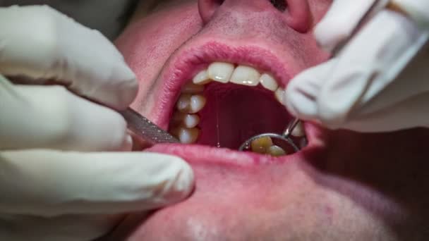 Dentista usando sus herramientas para comprobar la salud y posiblemente intervenir en los dientes de los pacientes — Vídeo de stock