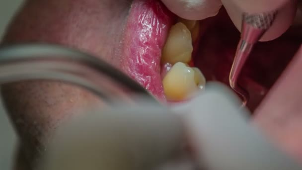 Detail schot van tandarts mending patiënt lager tanden — Stockvideo