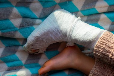 Topuk kırığında bandaj olan bir çocuk. Sağ ayağı kırık, yeni yürümeye başlayan çocuğun ateli. Küçük çocuk mavi bir battaniyenin üzerinde uyuyor.. 