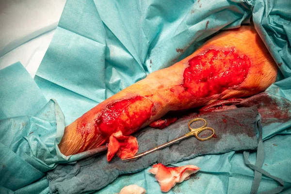 患者の腕は皮膚に重傷を負い — ストック写真