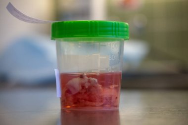 Ameliyattan sonra doku örneği formalin dolu bir kaba konur.