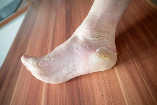 One Foot Skin Peels —  Fotos de Stock