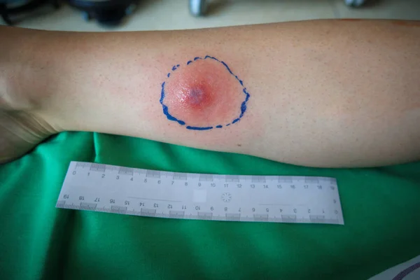 a tick bite has caused abscess on a forearm, a ruler is lying next to it for sizing