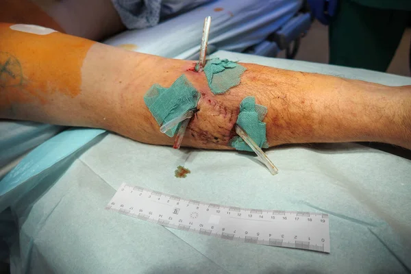 after a dog bite in the arm the wounds were treated in the hospital