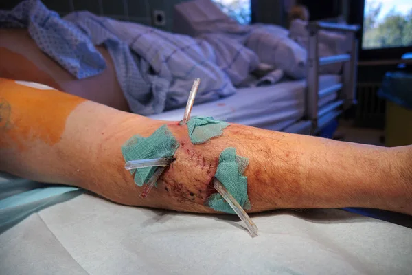 after a dog bite in the arm the wounds were treated in the hospital
