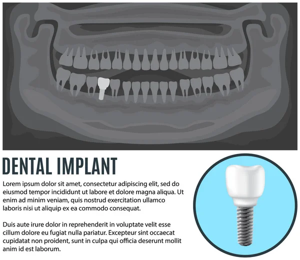 Fogászati implantátumokról szóló cikkből. Röntgen az emberi állkapocs egészséges fogak és protézis — Stock Vector
