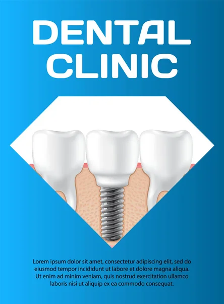 Emberi rágó egészséges fogakkal és műfogsorral a fogorvosi transzparensen. Orvosi fogorvosi plakát — Stock Vector