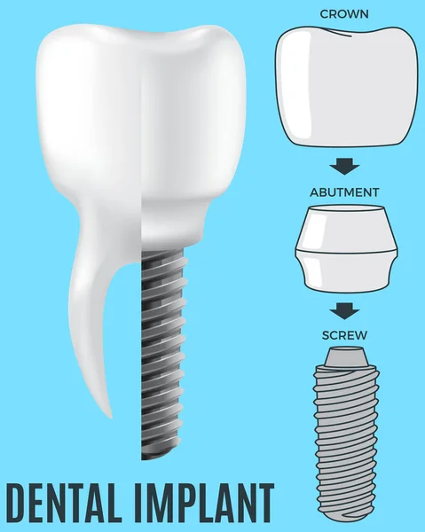 现实的白牙种植体和人的牙齿。牙科、医药和口腔保健 — 图库矢量图片