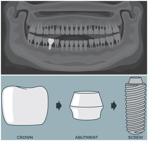 Radiografía en blanco y negro de la mandíbula humana con dientes y prótesis por encima de la estructura del implante dental — Archivo Imágenes Vectoriales