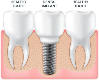 Normal dişleri ve diş implantı olan bir insan çenesi. Tedavi, dişçilik, ağız boşluğunun sağlık hizmetleri