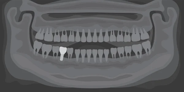 Rentgen lidské čelisti s normálními zuby a zubním implantátem. Radiografie s protézou v lepidle — Stockový vektor