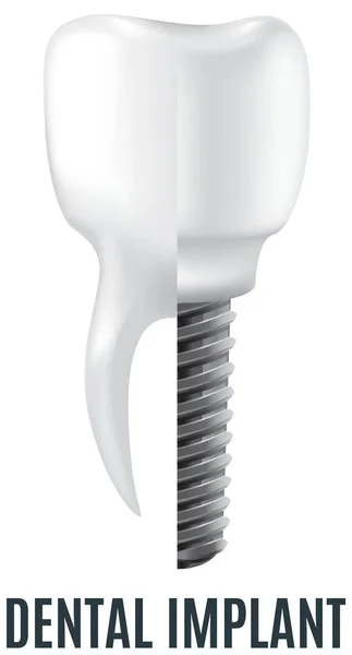 Implante dental blanco realista y diente humano. Odontología, medicina y salud de la cavidad oral — Vector de stock