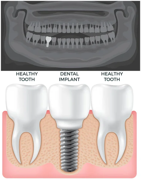 Radiografía en blanco y negro de la mandíbula por encima de la encía humana con dientes sanos normales e implante dental — Vector de stock