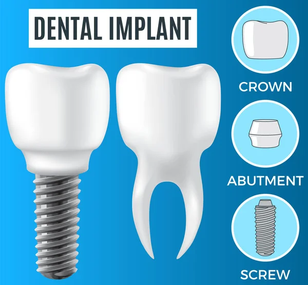 Implante dental blanco realista y diente humano. Odontología, medicina y salud de la cavidad oral — Archivo Imágenes Vectoriales