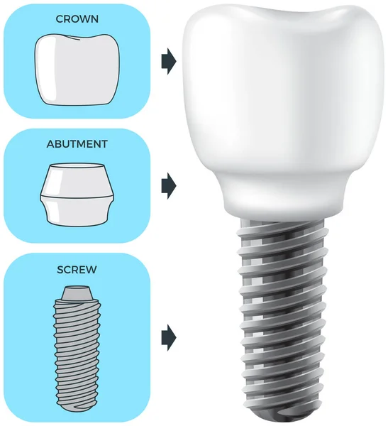 Reális fehér fogászati implantátum és emberi fog. Fogászat, orvostudomány és szájüreg-egészségügy — Stock Vector