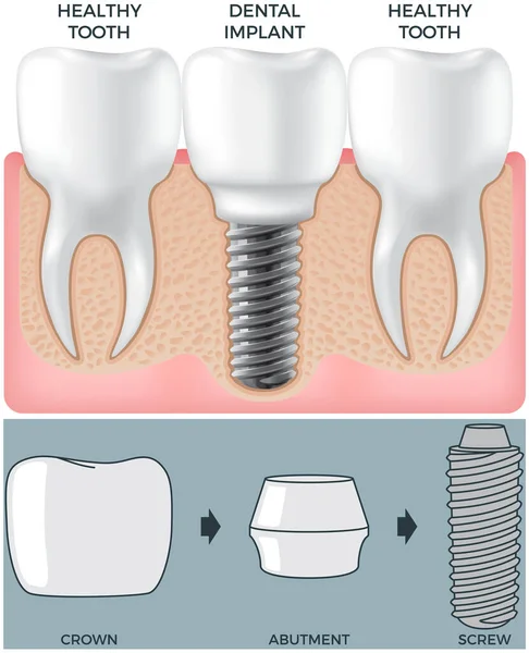 Emberi állkapocs normális egészséges fogakkal és protézissel a fogászati implantátum szerkezete feletti ínyben — Stock Vector