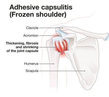 Frozen shoulder. Adhesive capsulitis. Labeled Illustration clipart