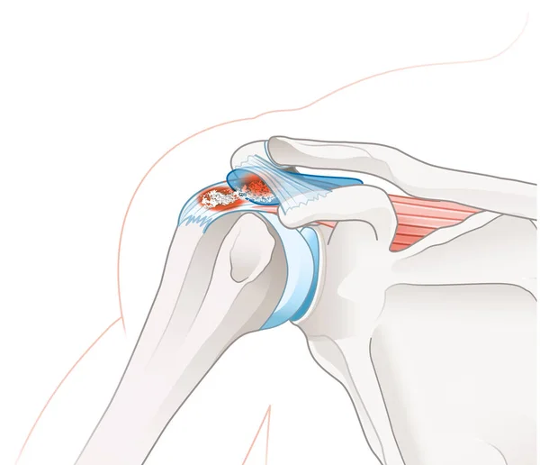 Ilustración Que Muestra Tendinitis Calcifica Bursitis Calcifica — Foto de Stock